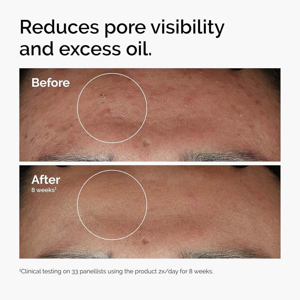 Lurxe | Niacinamide Zinc Face Serum